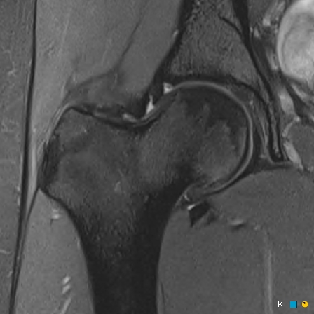 Figure 5 for case reverse slipped upper femoral epiphysis